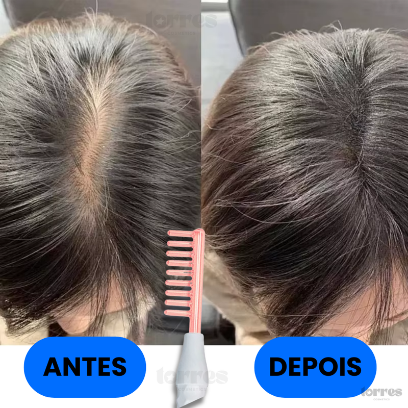 Pente Terapêutico de Alta Frequência - Terapia capilar em casa